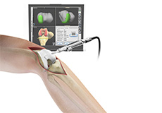 Computer Assisted Total Knee Replacement