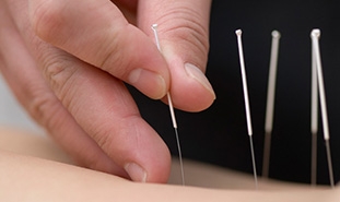 7 Reasons You Should Try Acupuncture