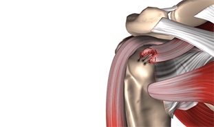 Advances in Arthroscopic Rotator Cuff Repair