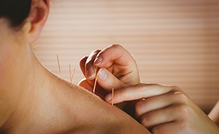 Am I a Candidate for Acupuncture?