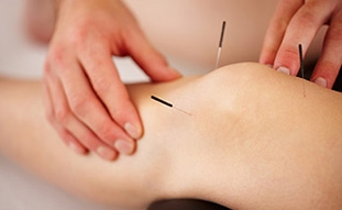 Find Healing in the New Year Through Acupuncture