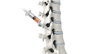 PRP injections for the Spine by Dr Kasra Rowshan