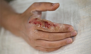 What is wound care?