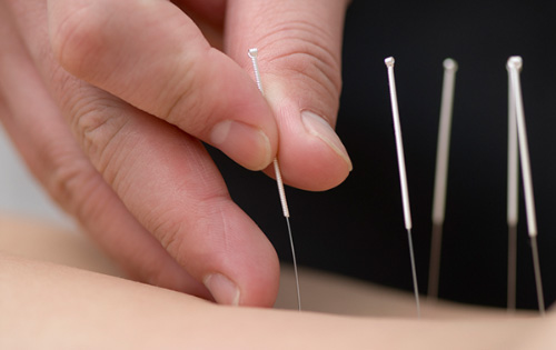 7 Reasons You Should Try Acupuncture