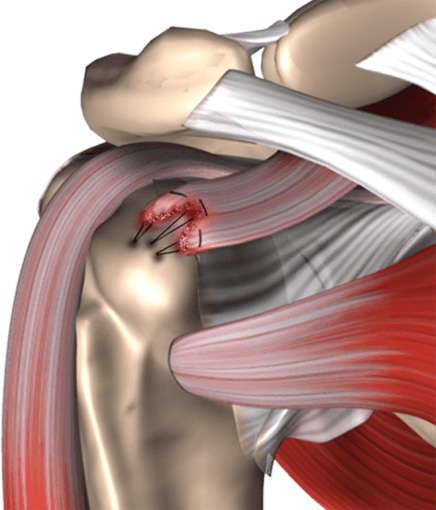 Advances in Arthroscopic Rotator Cuff Repair