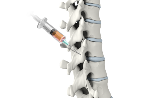 PRP injections for the Spine by Dr Kasra Rowshan