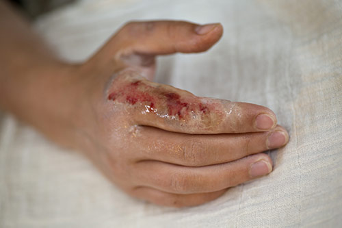 What is wound care?