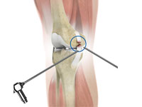 Arthroscopic Surgery