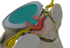 Cervical Microdiscectomy