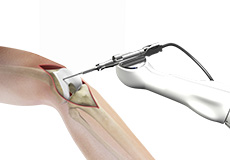 Computer Assisted Total Knee Replacement