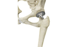 Joint Replacement Surgery