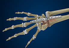 Arthrodesis